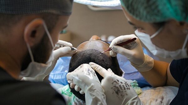 Hvad kan du forvente af en hårtransplantation? En personlig beretning